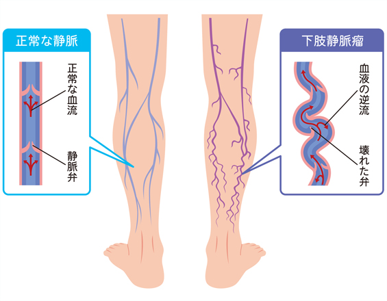 下肢静脈瘤の図
